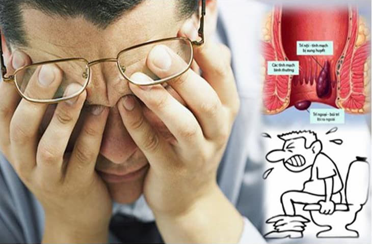 Tham khảo ngay các cách điều trị trĩ nội để tạm biệt cảm giác đau ngứa, khó chịu