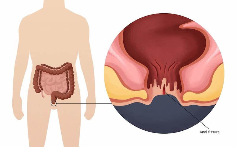Đau rát hậu môn cũng có thể là triệu chứng của bệnh nứt kẽ hậu môn