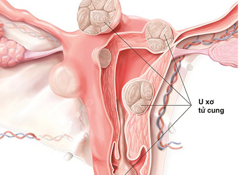 phẫu thuật nội soi 