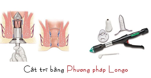 Mô phỏng phương pháp cắt trĩ Longo