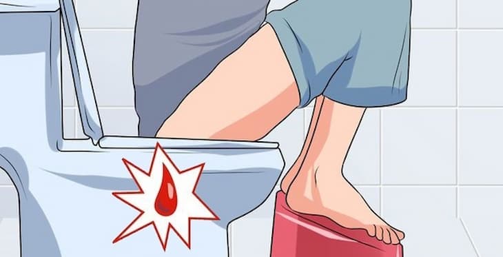Symptoms of thrombosed hemorrhoids