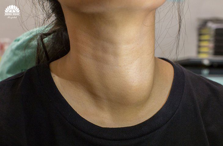 Biểu hiện bệnh u tuyến giáp