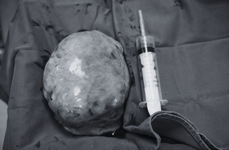 A large uterine fibroid mass successfully managed surgically at Hong Ngoc General Hospital.