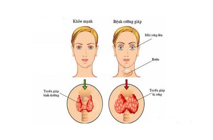 Cường tuyến giáp gây ra lồi mắt