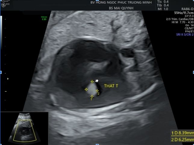 Siêu âm tim thai