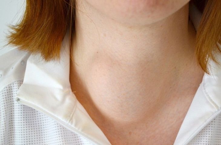 Bệnh u tuyến giáp kiêng ăn gì để không bị biến chứng nặng?