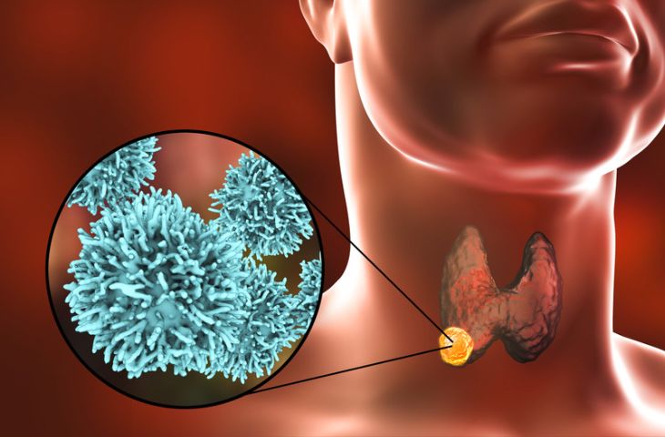 Ung thư tuyến giáp có nguy hiểm không