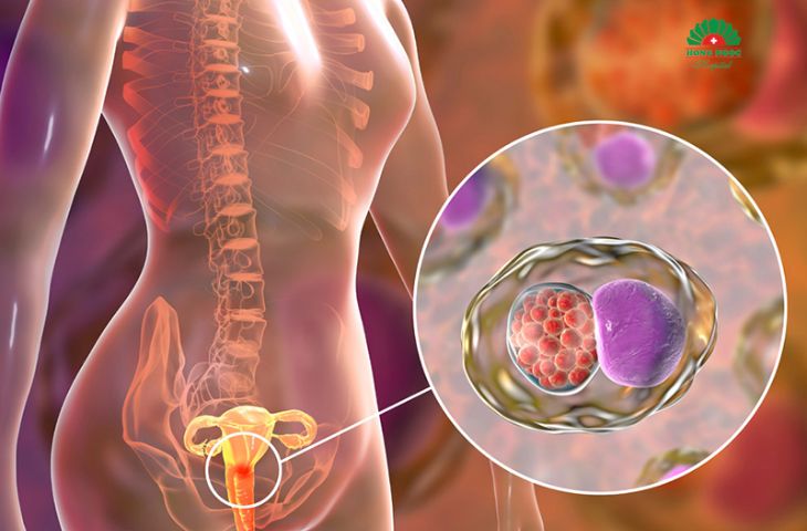 Viêm phụ khoa nặng do HPV