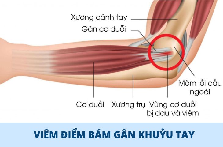 viêm điểm bám gân