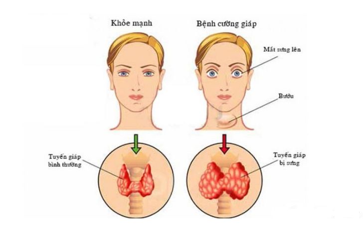 Lồi mắt là triệu chứng của bệnh tuyến giáp