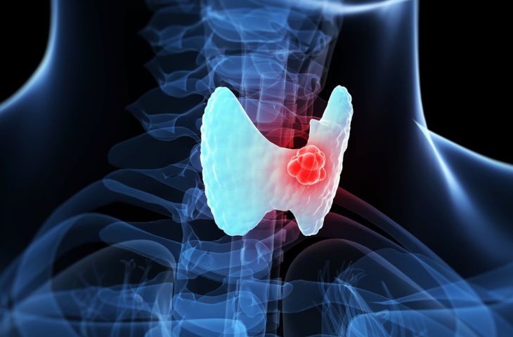 甲状腺癌不可忽视的5大并发症