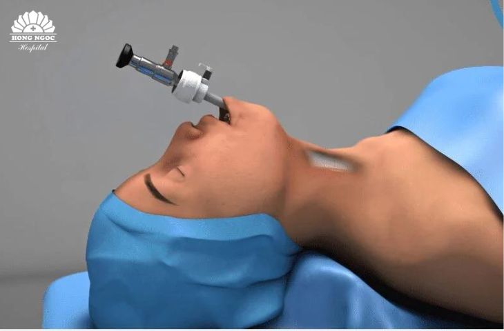 Bước 3 mổ nội soi tuyến giáp qia đường tiền đình miệng