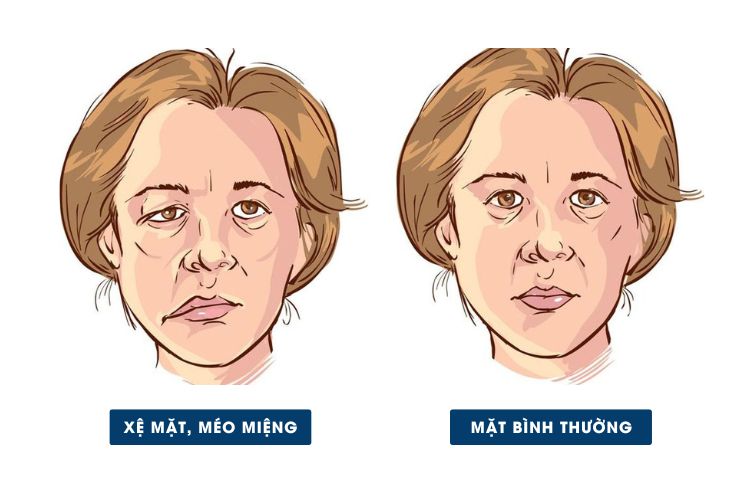  liệt dây thần kinh số 7