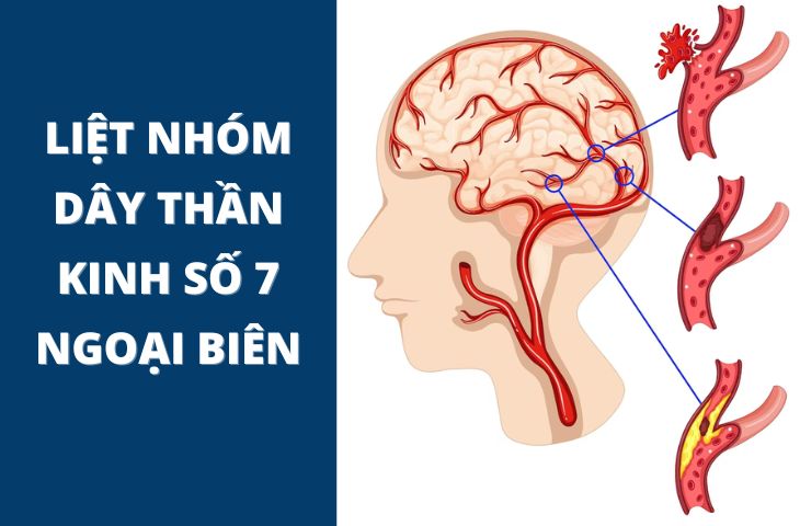  liệt dây thần kinh số 7