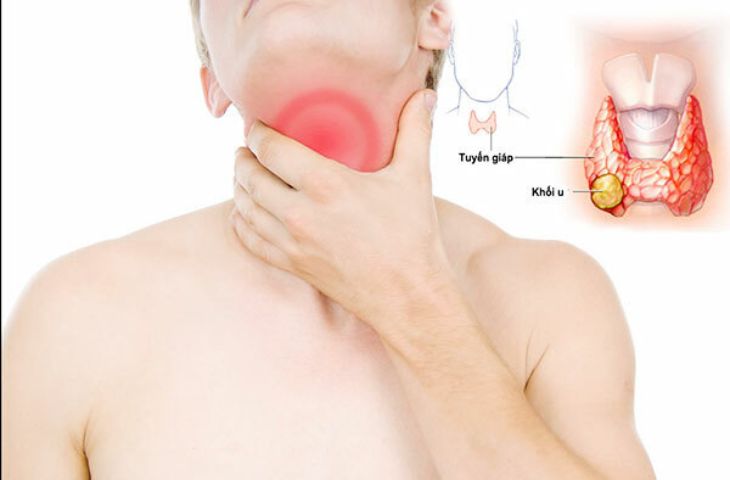 Nguyên nhân bị tuyến giáp là gì?