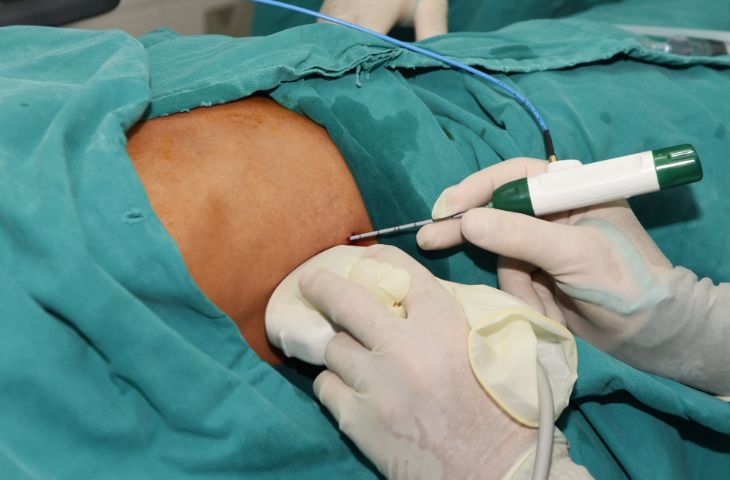 Sóng cao tần RFA