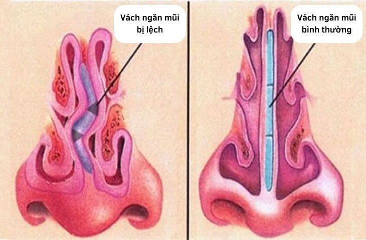 Nguyên nhân gây viêm đa xoang