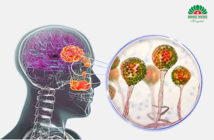 Biến chứng viêm xoang do nhiều nguyên nhân