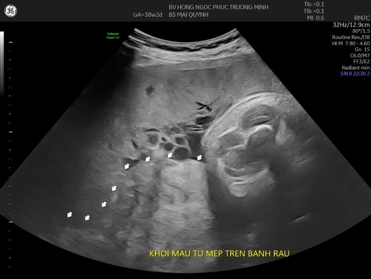 Rau bong non