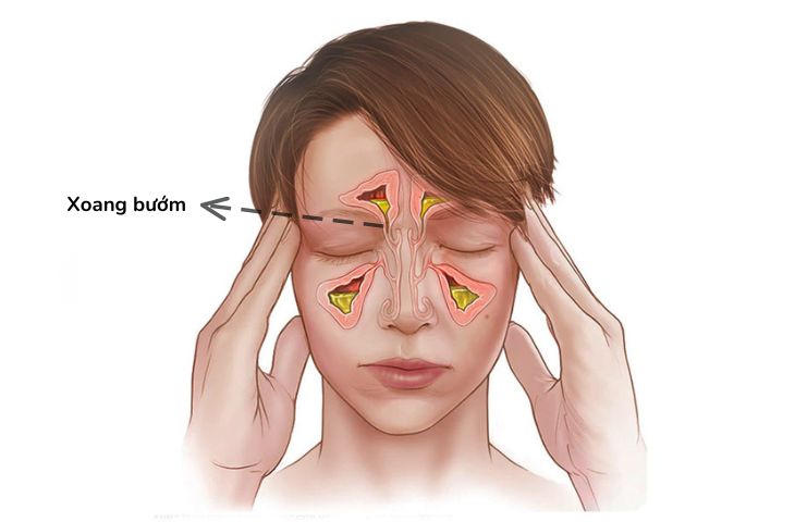 Vị trí xoang bướm