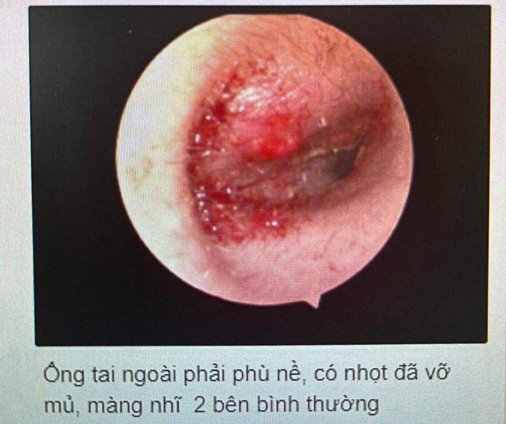 Viêm tai ngoài do đi bơi