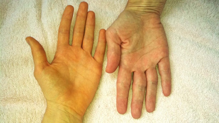 Vàng da, vàng mắt là một trong những biểu hiện điển hình của ung thư gan giai đoạn đầu