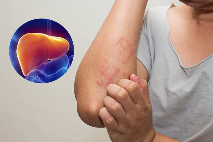 Biểu hiện ngứa da ở người bị ung thư gan giai đoạn đầu