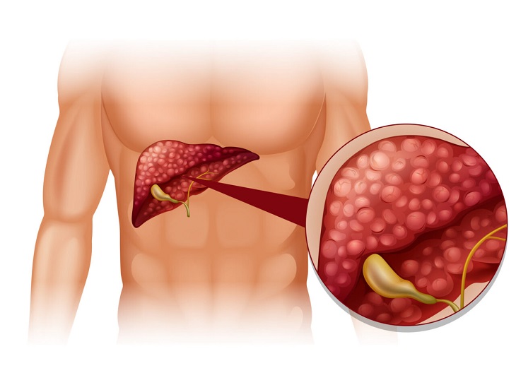 Nguyên nhân gây bệnh ung thư tế bào gan nguyên phát&nbsp;