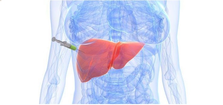Thực hiện sinh thiết chẩn đoán viêm gan