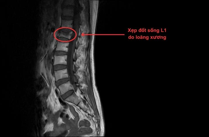 truyền loãng xương
