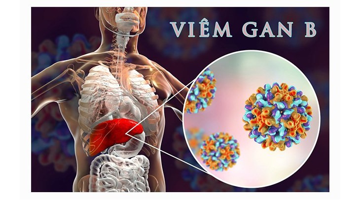 Nguyên nhân gây ung thư biểu mô tế bào gan có thể do biến chứng của viêm gan B&nbsp;