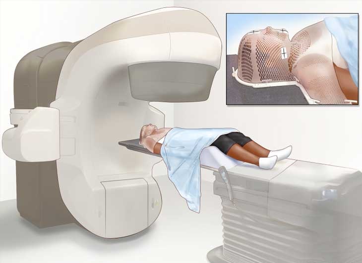 Xạ trị giúp giảm triệu chứng của ung thư biểu mô tế bào gan&nbsp;