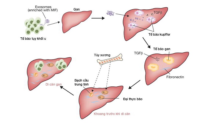 Primary liver cancer progresses through five distinct stages.