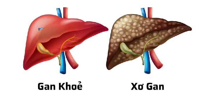 Patients with cirrhosis have a significantly higher risk of developing liver cancer compared to the general population.