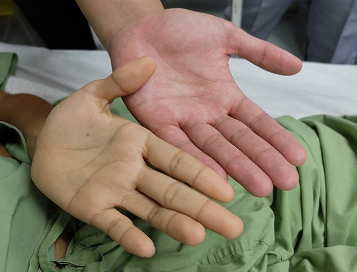 Jaundice is one of the characteristic clinical manifestations of liver cancer.