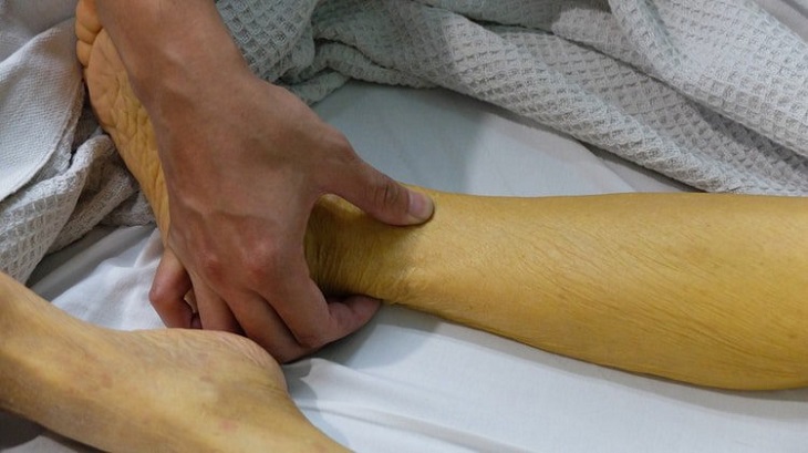 Người bị ung thư gan phải chịu tác động triệu chứng của khối u nguyên và thứ phát