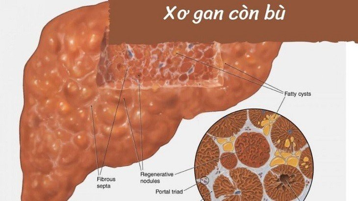 Xơ gan còn bù hoàn toàn có thể phục hồi và tái tạo chức năng của biểu mô gan