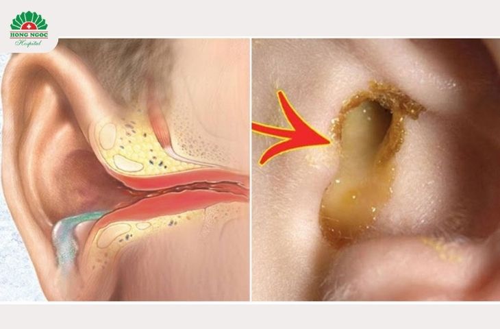 Chảy dịch vàng, có mùi hôi từ trong tai là dấu hiệu điển hình của nhiễm trùng tai