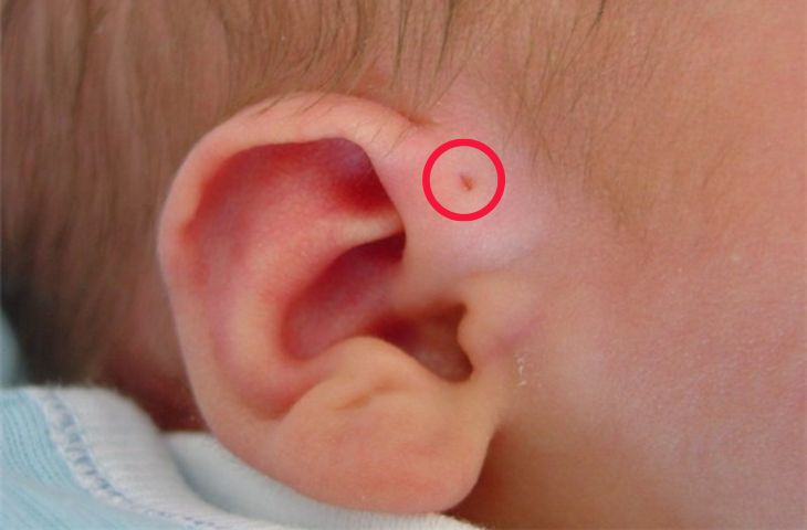 Phẫu thuật lấy đường rò luân nhĩ - Dấu hiệu nhận biết