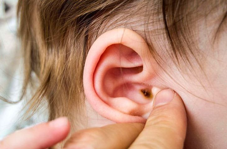 Triệu chứng viêm ống tai ngoài điển hình