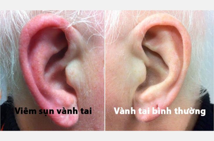 Dấu hiệu viêm sụn vành tai
