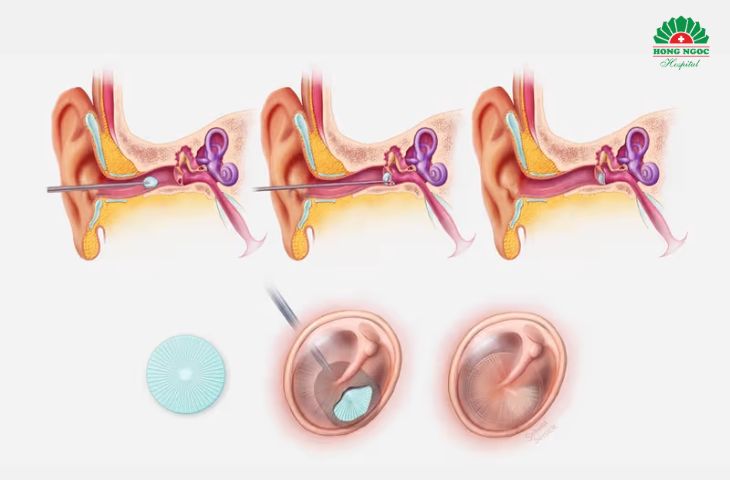 Quy trình phẫu thuật vá màng nhĩ