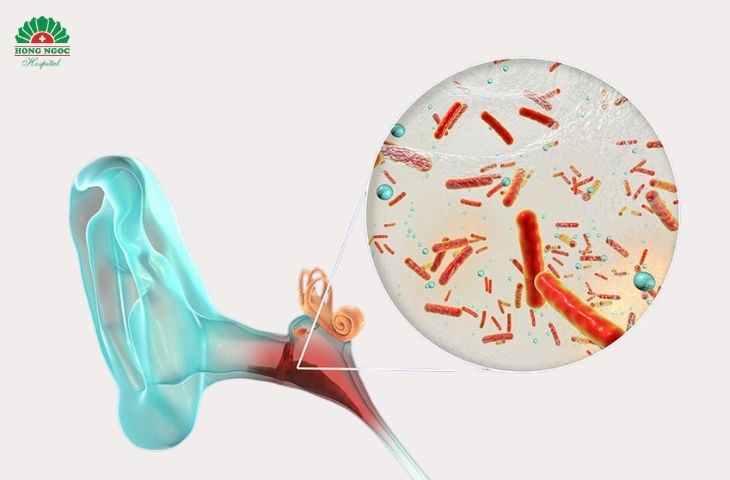 Các loại vi khuẩn, virus là nguyên nhân phổ biến nhất dẫn đến nhiễm trùng tai