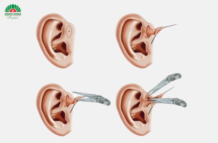 Quy trình phẫu thuật lấy đường rò luân nhĩ