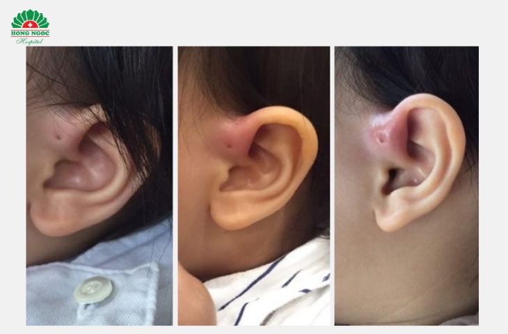 Cần phẫu thuậy lấy đường rò luân nhĩ khi có dấu hiệu áp xe