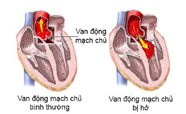 Hở van động mạch chủ ¼ là gì? Hở van động mạch chủ ¼ tương ứng với tỷ lệ 25%