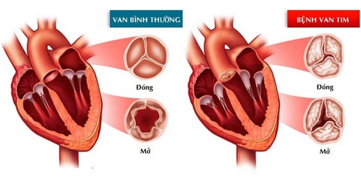Thông sàn nhĩ thất toàn phần