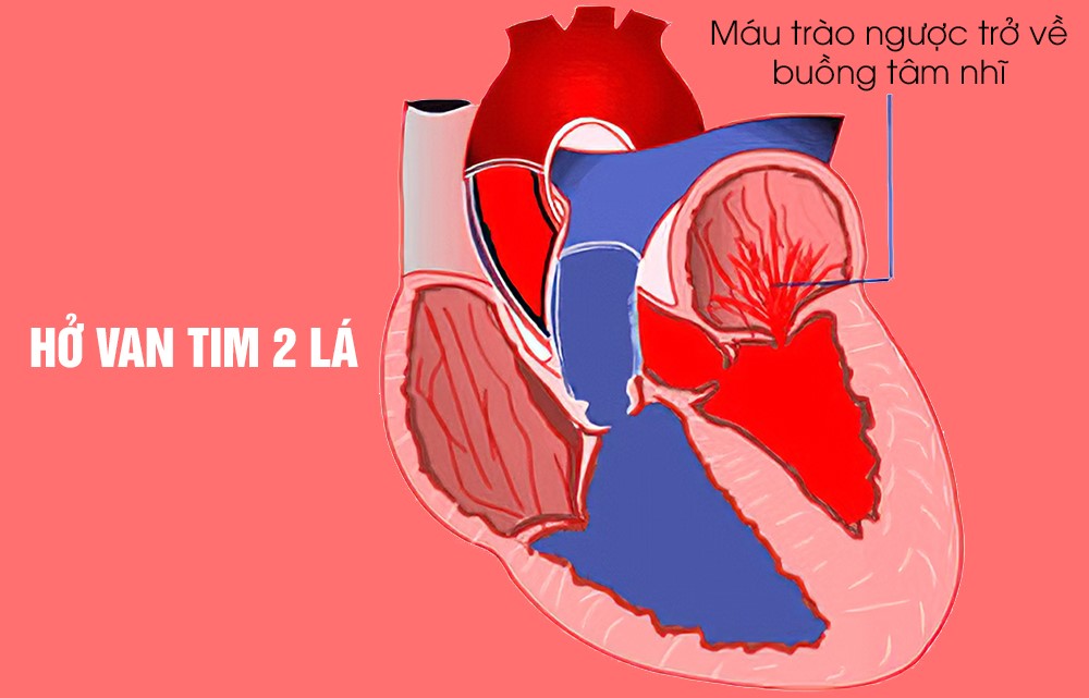 Hở van tim là biến chứng nguy hiểm của bệnh cơ tim giãn