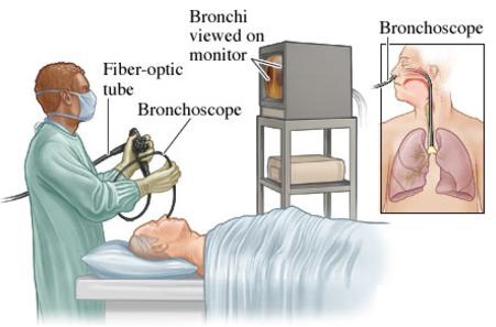nội soi phế quản