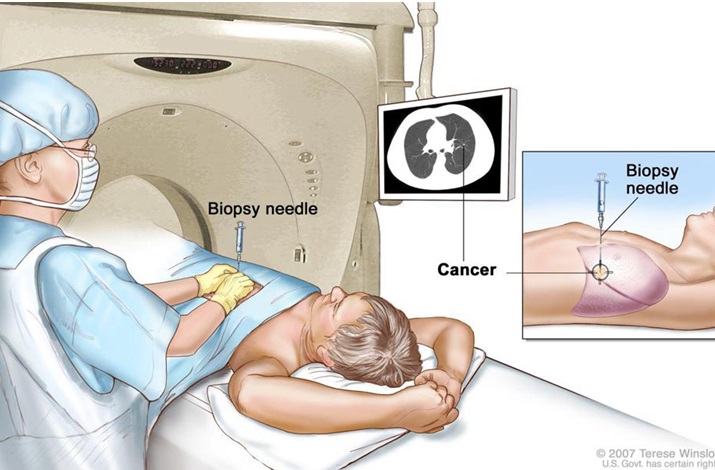 lấy sinh thiết phổi có nguy hiểm không
